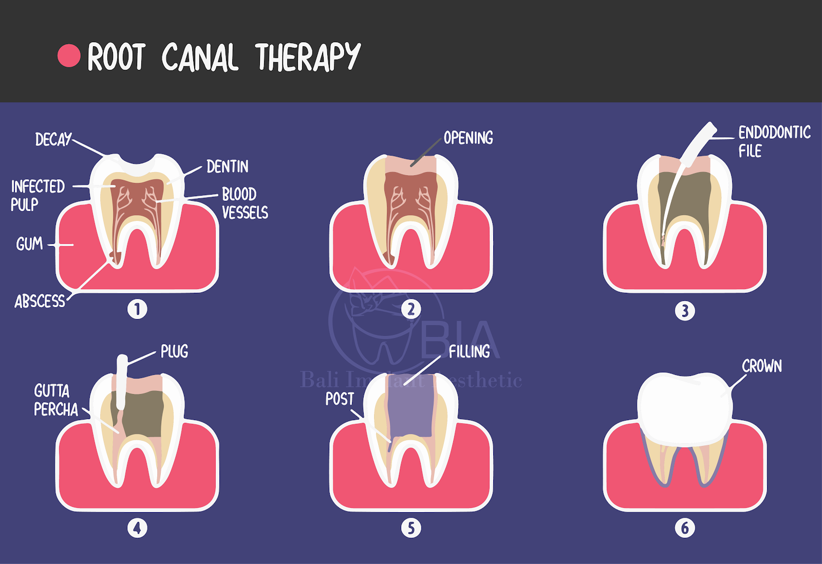 Root Canal vs Filling: What Procedure Do I Need? - Putney Dental Care