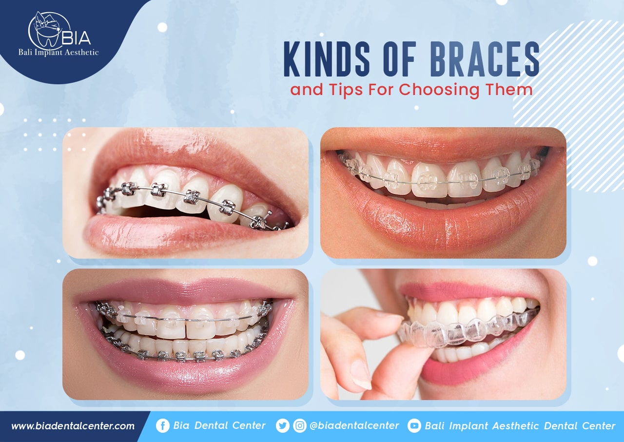 Kinds of Braces and Tips For Choosing Them - Bali Implant Aesthetic (BIA)  Dental Center