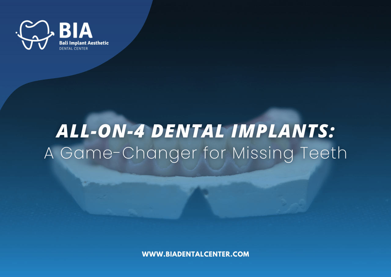 All-on-4 Dental Implants: A Game-Changer for Missing Teeth