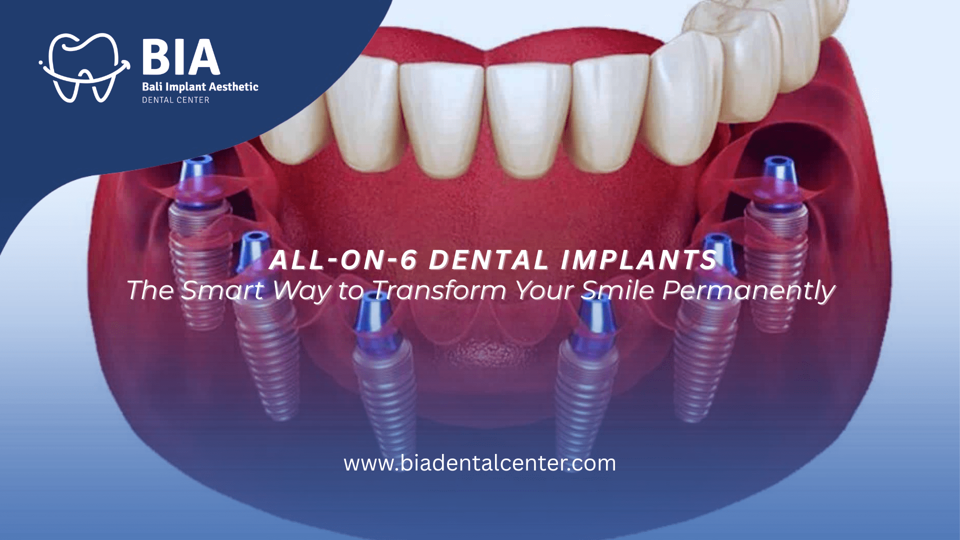 All-on-6 Dental Implants: The Smart Way to Transform Your Smile Permanently