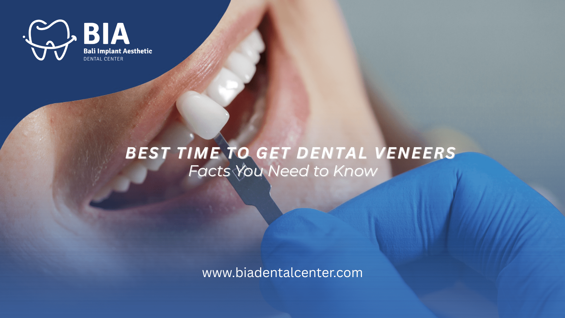 Best Time to Get Dental Veneers