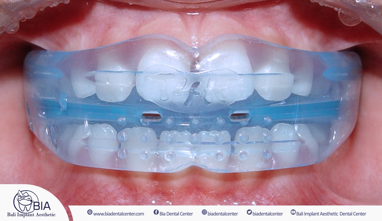 Light Blue Braces - DentaCenter