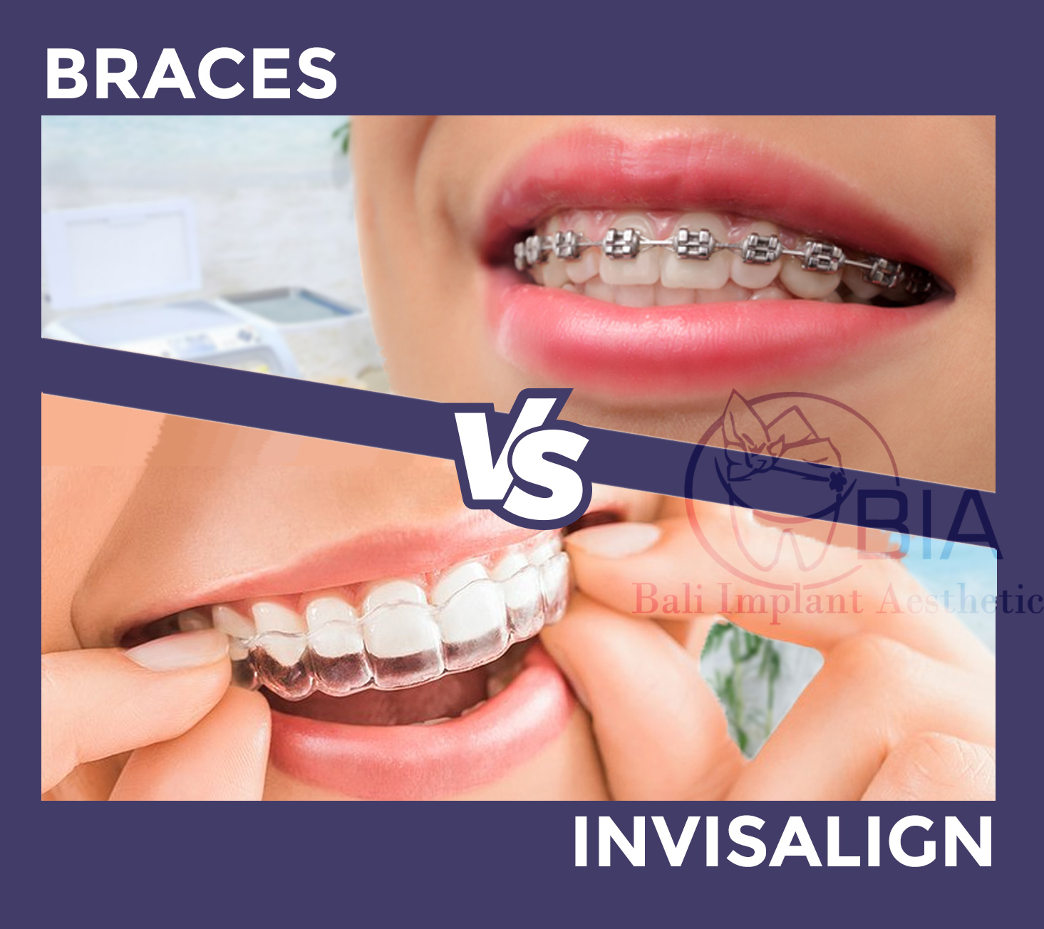 invisalign vs braces