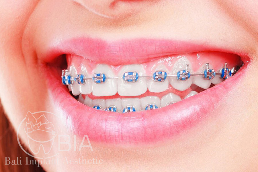 invisible braces with color