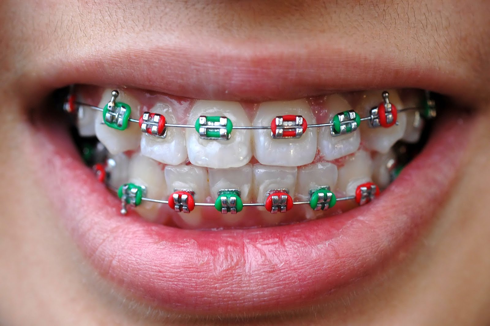 Metal Braces vs. Invisalign - Bali Implant Aesthetic (BIA) Dental