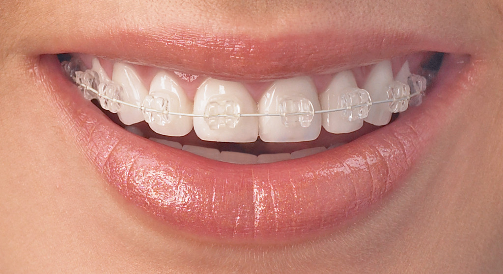 Metal Braces vs. Invisalign - Bali Implant Aesthetic (BIA) Dental