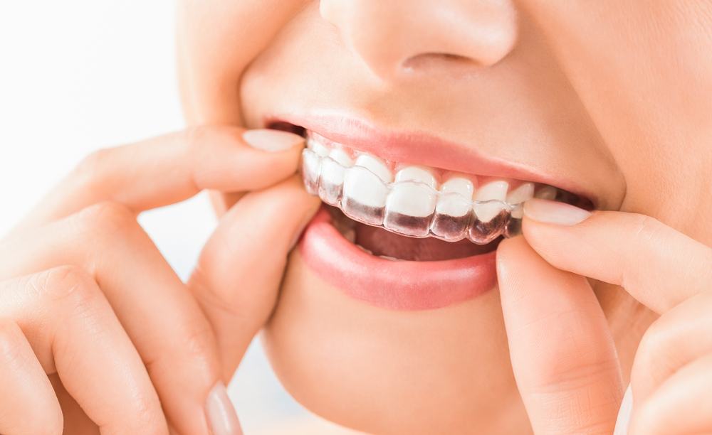 Metal Braces VS Clear Braces - Bali Implant Aesthetic (BIA) Dental Center