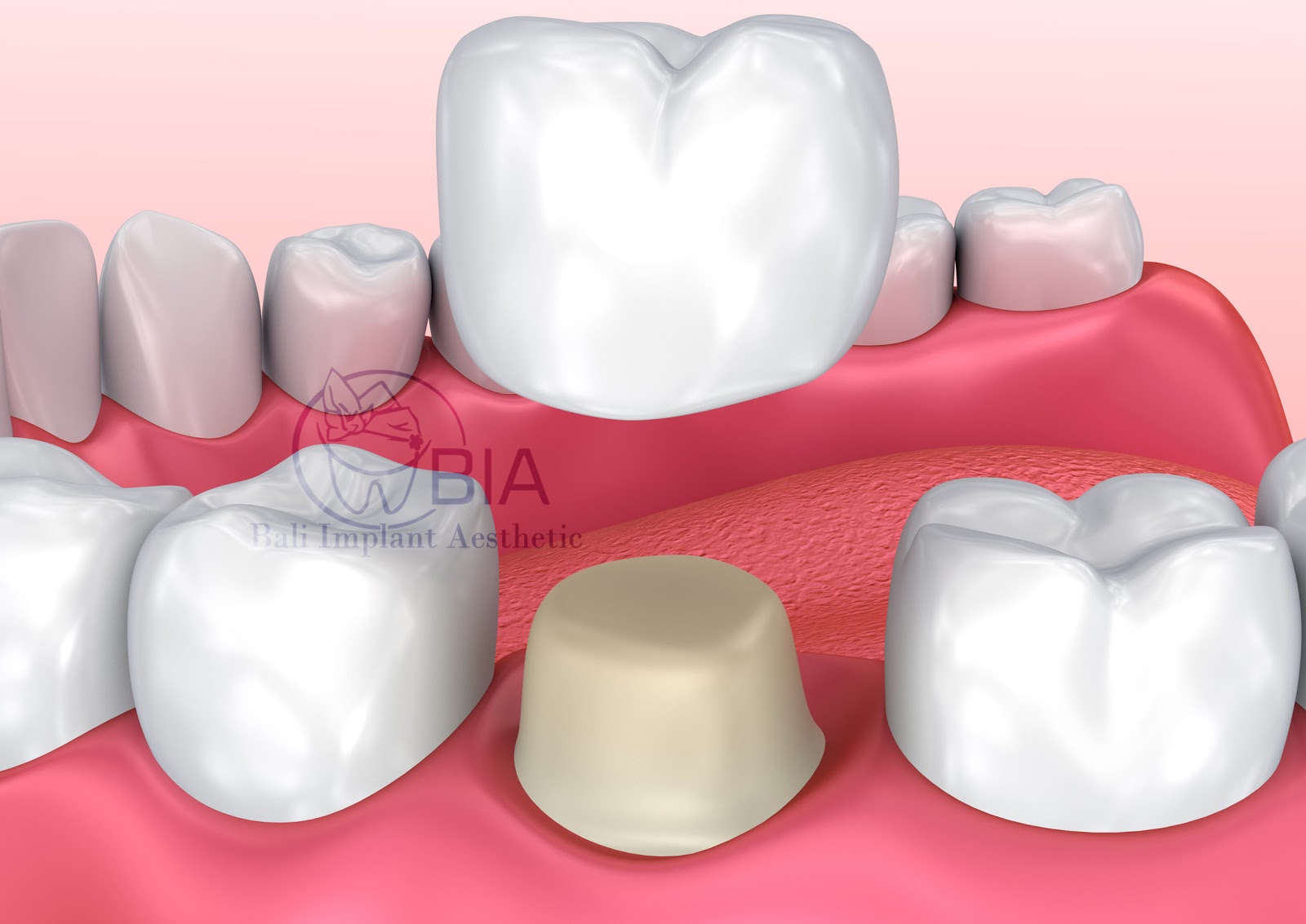 Onlay VS Dental Crown - Bali Implant Aesthetic (BIA) Dental Center