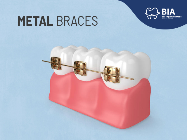 Metal Braces - Bali Implant Aesthetic (BIA) Dental Center